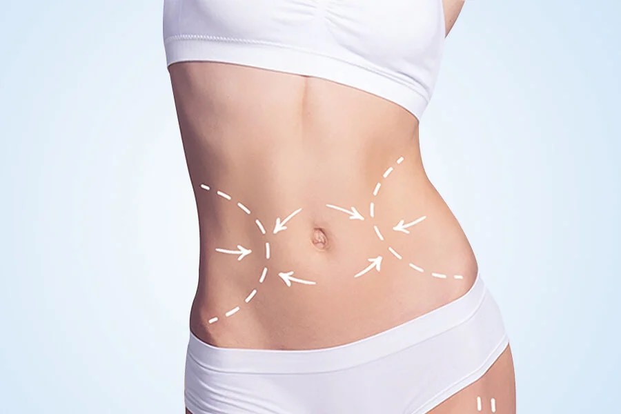 abdominoplastika