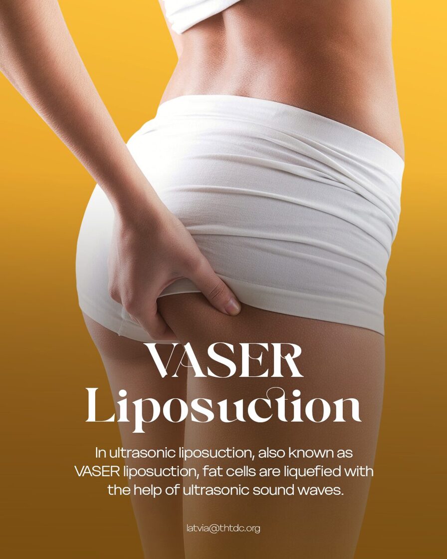 vaser liposuction