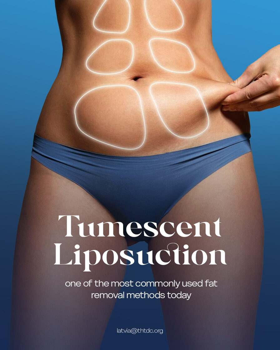 tumescent liposuction